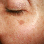 Pigmentvlekken verwijderen brown spots under the eye. pigmentation on the face.
